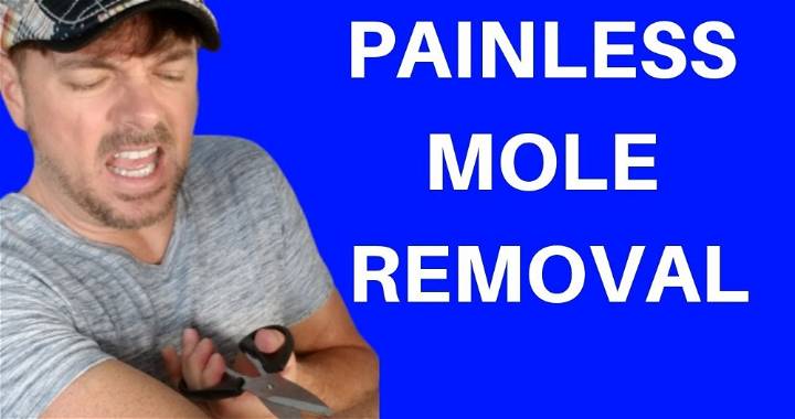 how to remove a mole and skin tags yourself